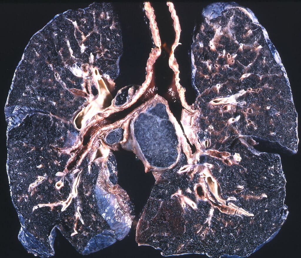 Health experts have expressed concern that exposure to dust from engineered stone can cause Silicosis. (Photo Credit: Dr. Yale Rosen Atlas of Pulmonary Pathology via Flickr on WikiCommons Creative Commons Licence)