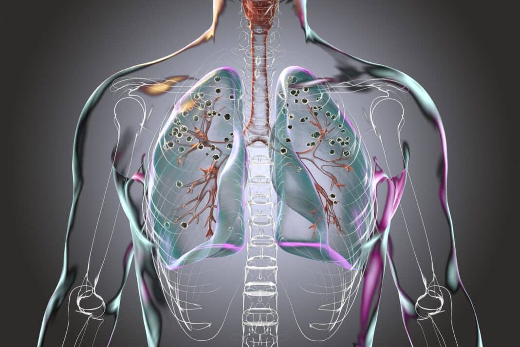 Prolonged exposure to fine particles of respirable crystalline silica causes scarring of the lungs, and is also associated with kidney disease, and autoimmune conditions like rheumatoid arthritis. (Photo Credit: Dr_Microbe via Adobe Stock Photos)